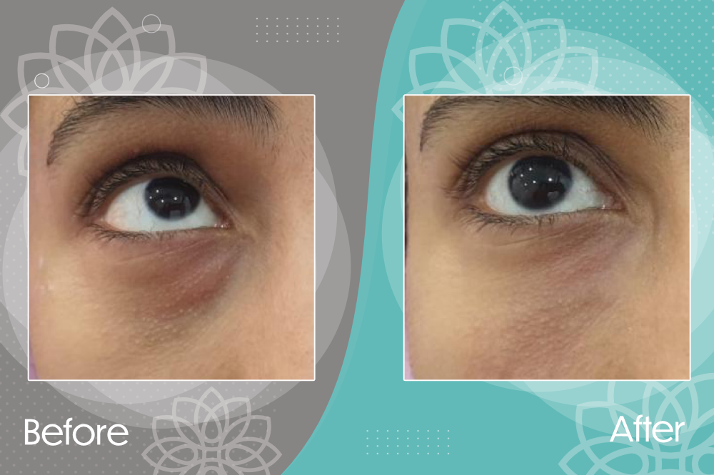 Dermal fillers for dark hallos under eye which works to boost collagen production