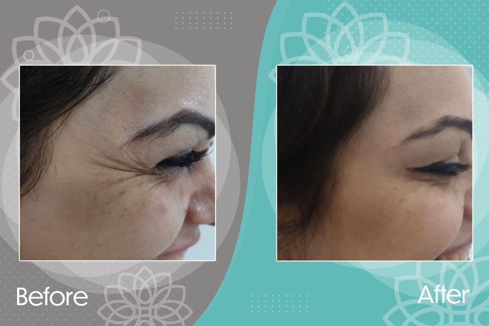 Eliminate aging &amp; expression signs