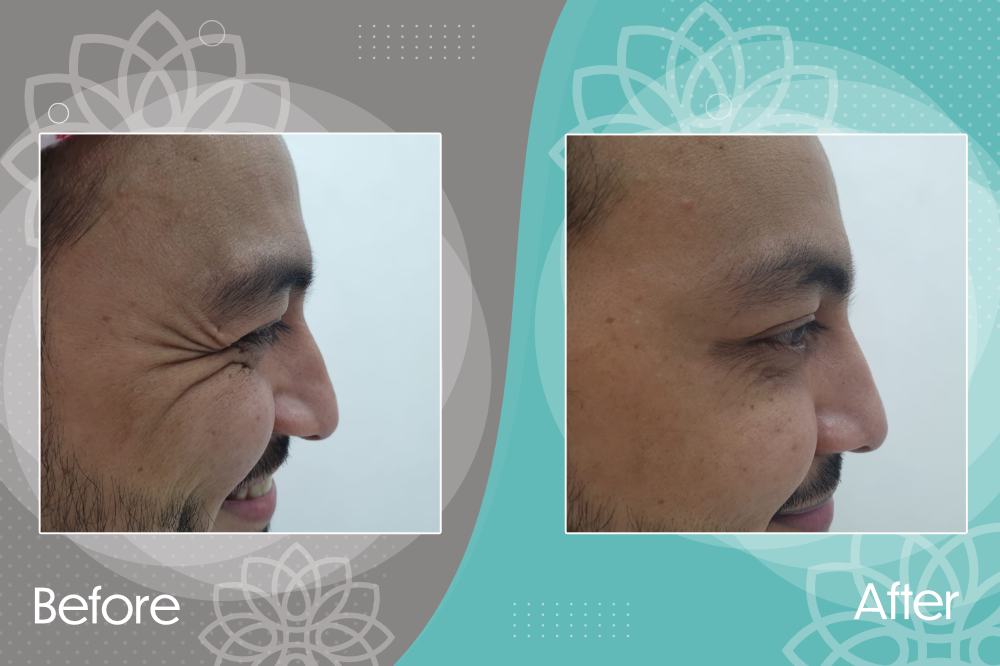 Botox injection to improve wrinkles around the eyes