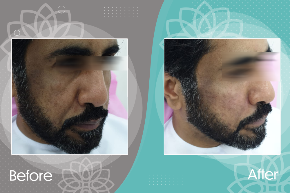 Face Lifting, Tear Trough &amp; Nasolabial Line Correction