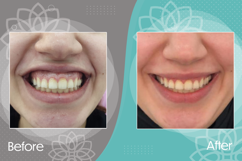 Correction of Gummy Smile by Botox Injection