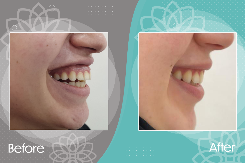 Correction of Gummy Smile by Botox Injection