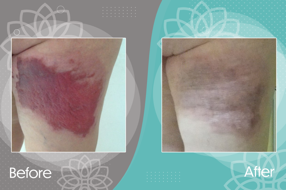 Treatment of a post burn scar.