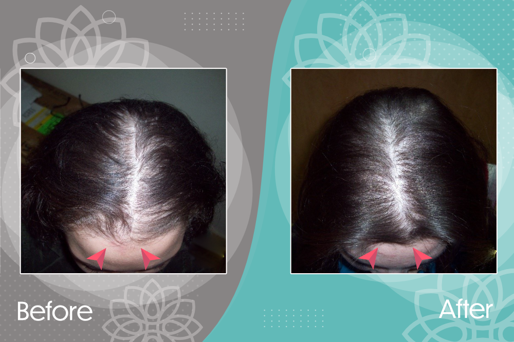 Treatment of female androgenetic alopecia, note the improvement in the frontal area.