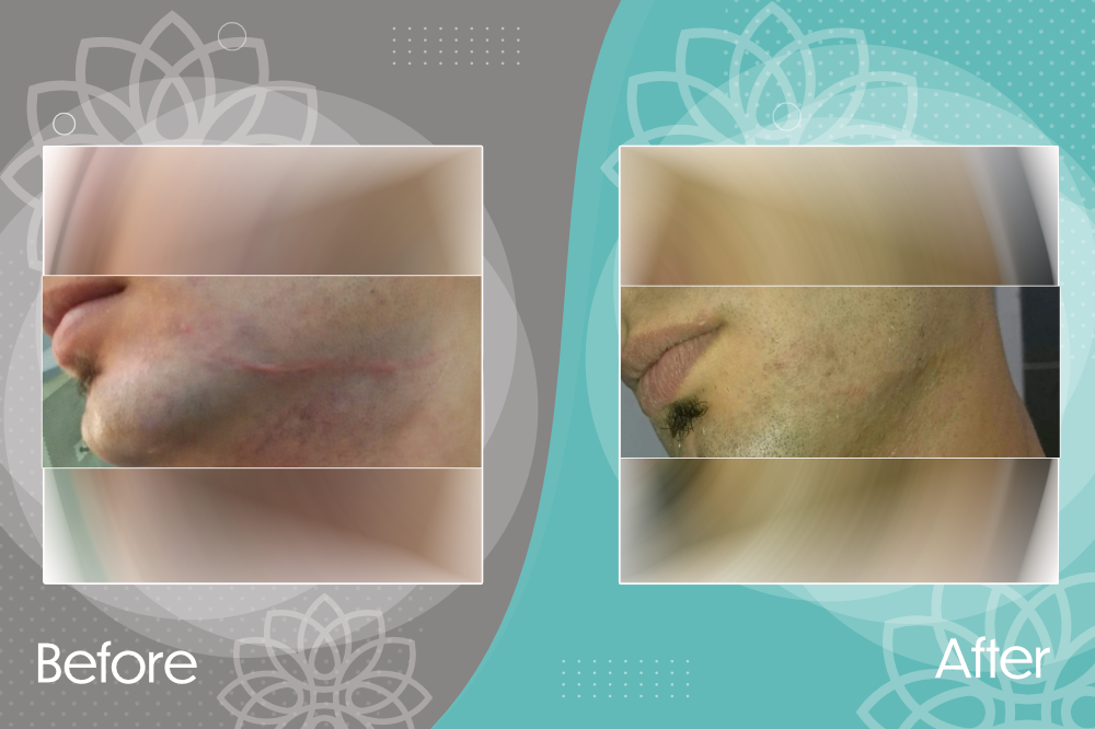 Treatment of hypertrophic scar due to a cut wound.