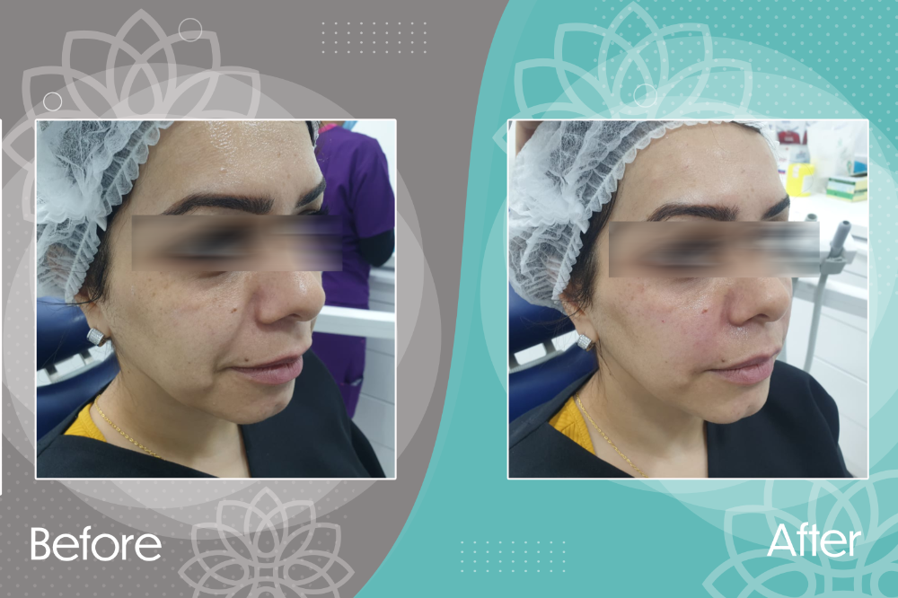 Nasolabial line improvement by filler injection.