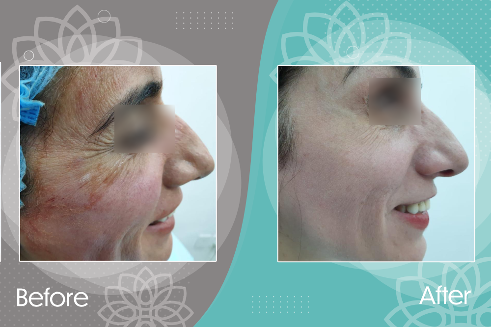 Eliminating crow's feet by botox injection and treating skin pigmentation by cold peel
