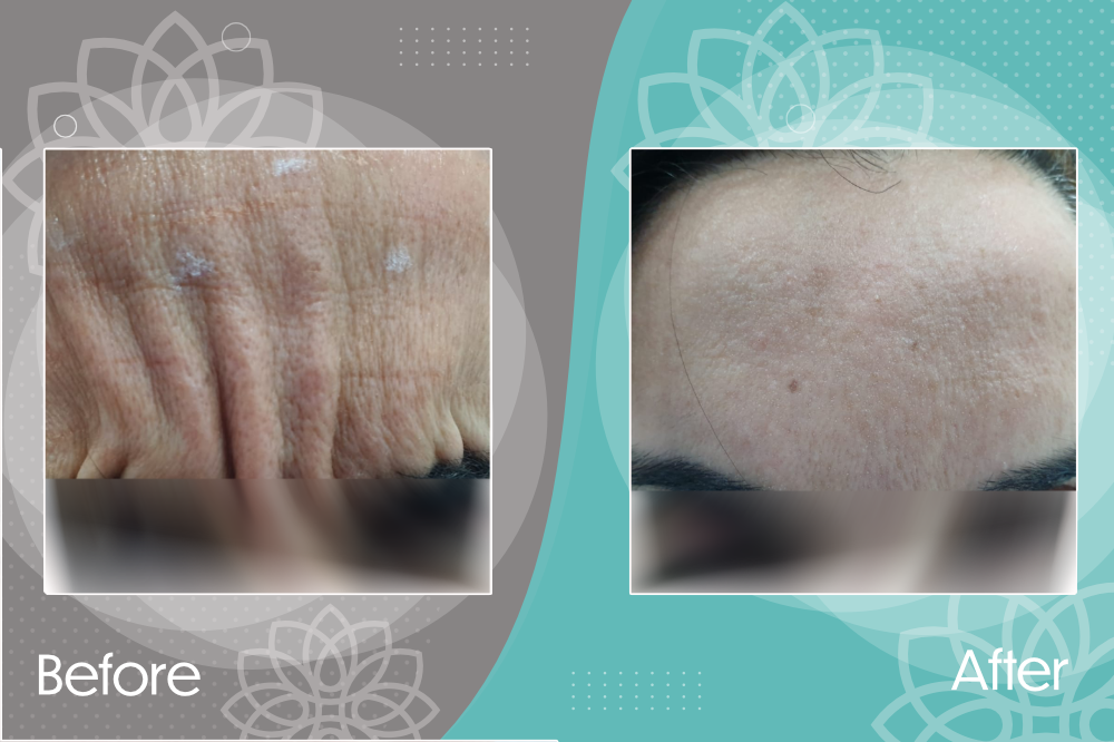 Improving glabellar contraction lines through botox injection.