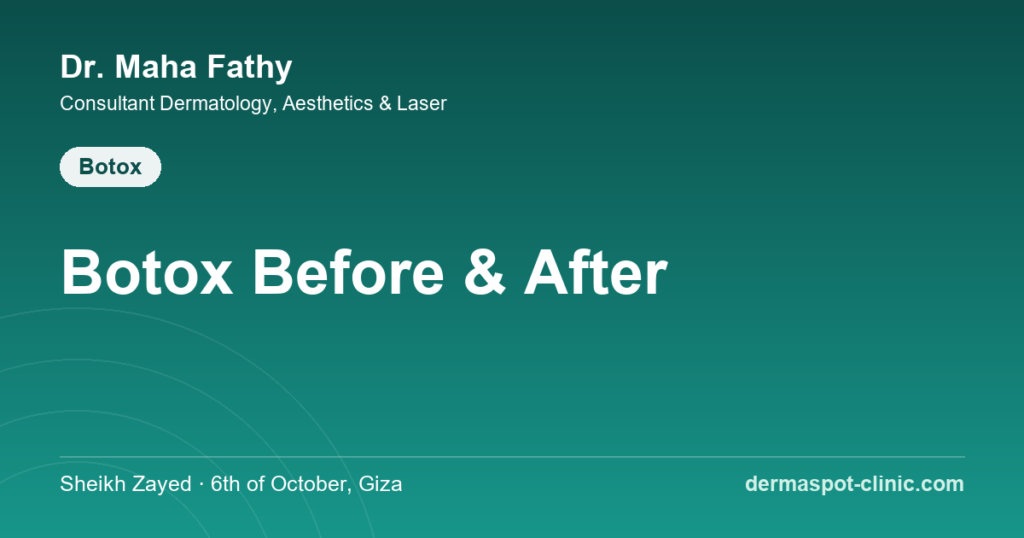 Botox before and after - realistic results, Dr. Maha Fathy DermaSpot